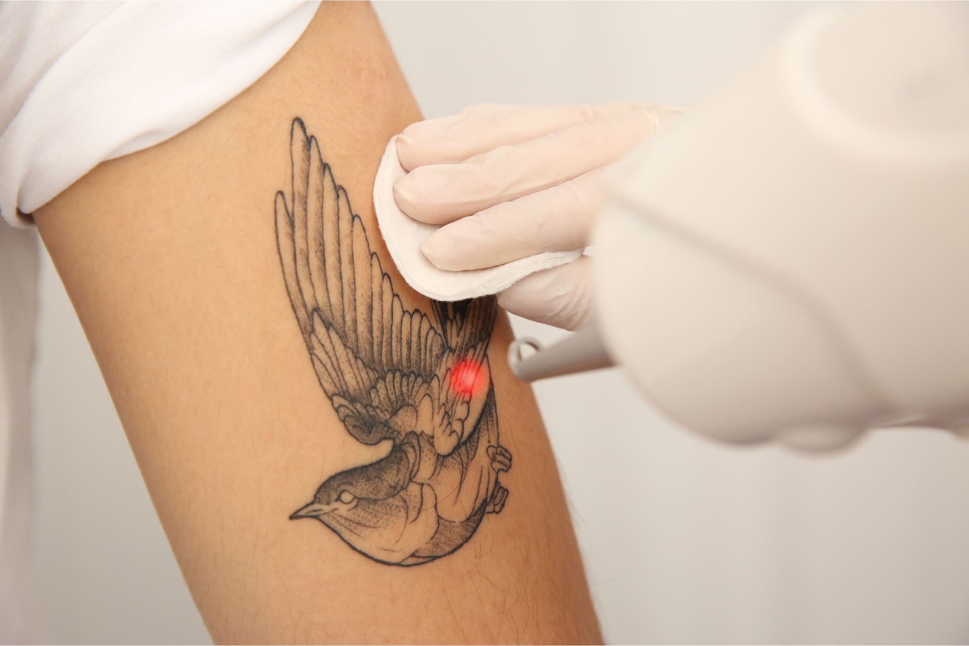 tatoo removal